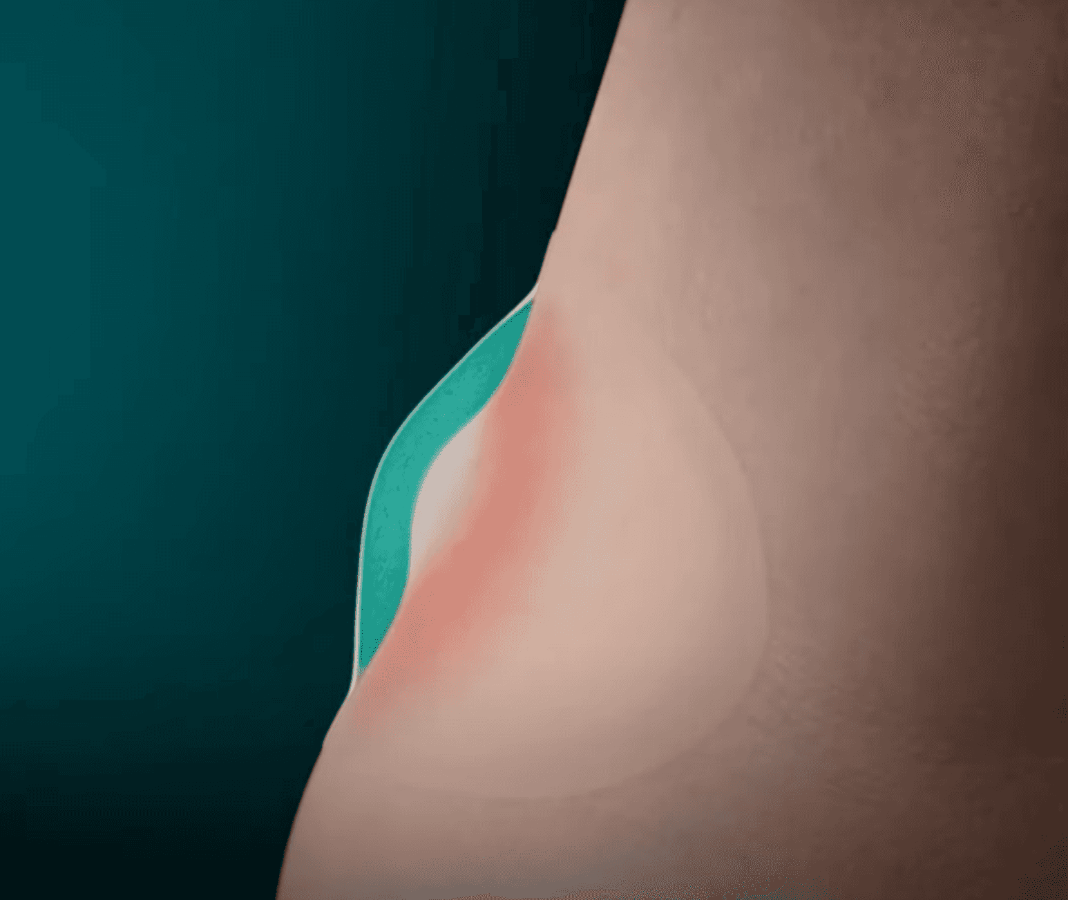 illustration of blister plaster on blister
